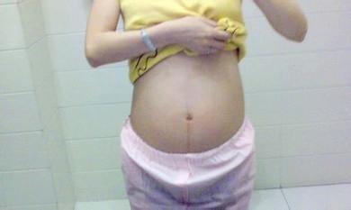 妈妈剖腹产怎么缝合,妈妈剖腹产宝宝出来怎样护理