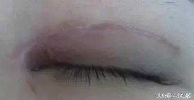 你的眼睛适合做什么手术,你的双眼皮什么时候做