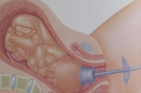 产钳助产的正确使用方法,准妈妈必备婴儿电器