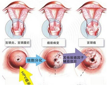 hpv35阳性宫颈癌的几率,hpv全阴性得宫颈癌的几率大么