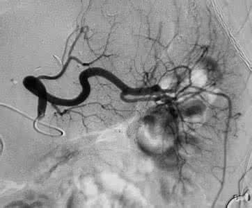 什么样的房颤需要抗凝治疗,房颤是药物治疗好还是手术治疗好