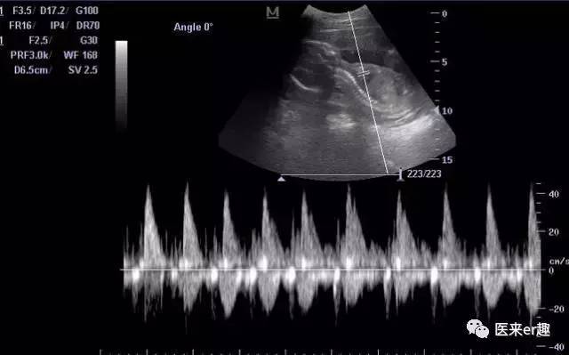 孕期超声提示胎儿心室强回声怎么办？