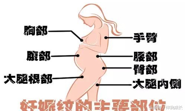 一分钟带您搞懂妊娠纹