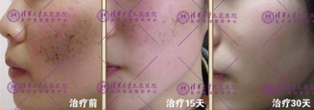 遗传雀斑激光会反弹吗,海口祛雀斑激光不反弹哪个医院好