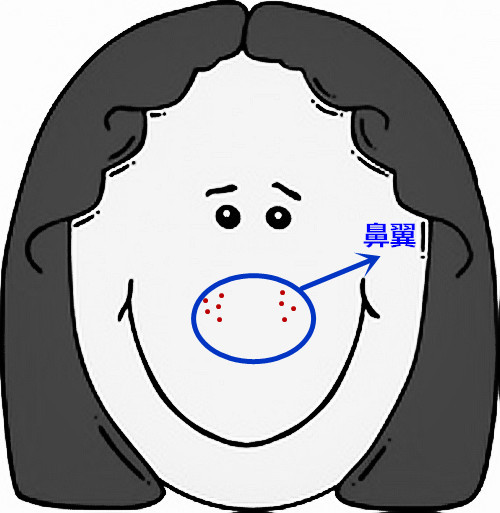 面部痘痘严重程度检测,痘痘面部分析