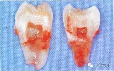 口腔拔牙图片,口腔拔牙麻醉多久消退