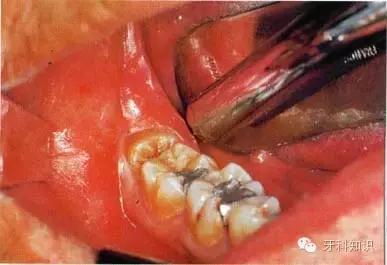 口腔拔牙图片,口腔拔牙麻醉多久消退