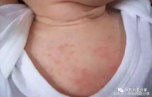 宝宝长痱子怎么办？如何预防、治疗这篇全都有！