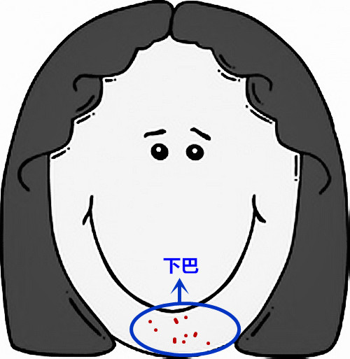 超全面面部痘痘分析图文，了解身体状况！