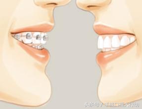 牙齿矫正需要费用大概多少,深度揭秘牙齿矫正到底需要多少钱