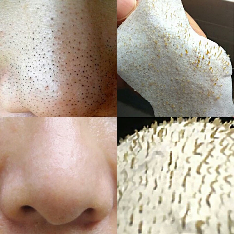 全面解析粉刺解决方法大全,教你几招认识痘痘才能真正根治