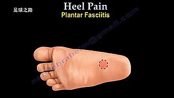足跟痛的症状及表现,足跟痛最常见病因