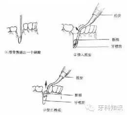 口腔拔牙图片,口腔拔牙麻醉多久消退