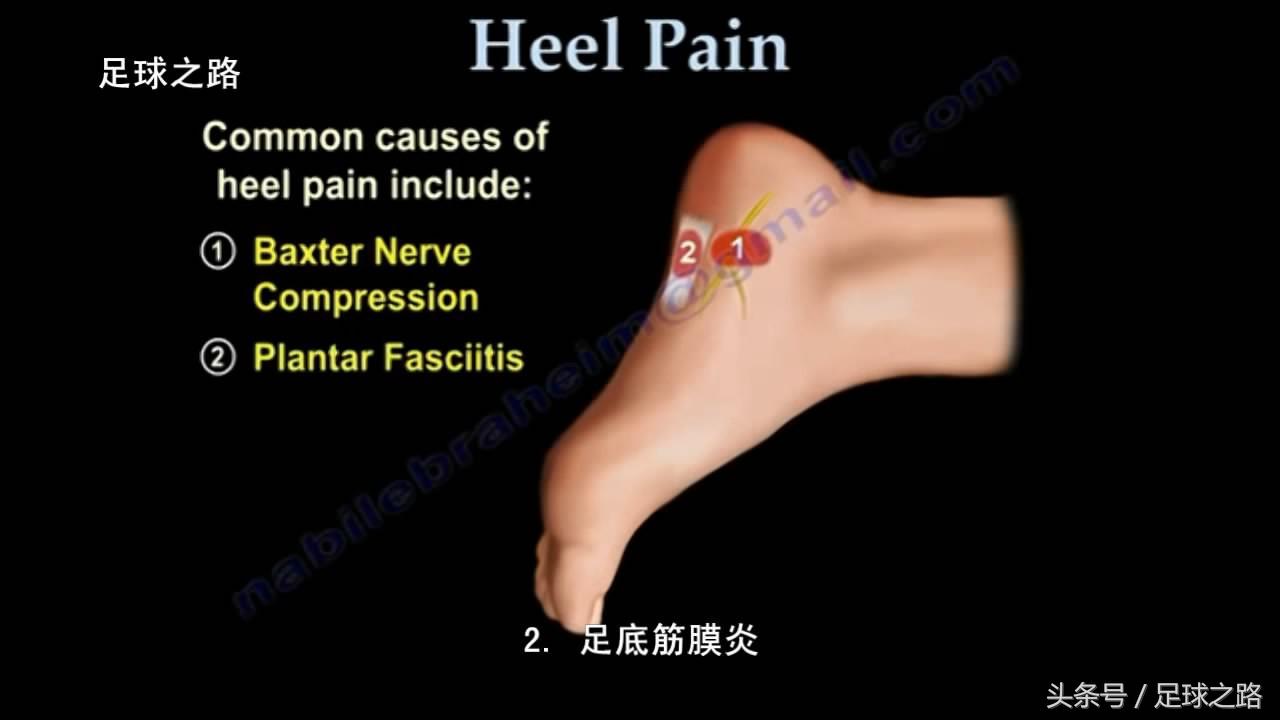 足跟痛的症状及表现,足跟痛最常见病因