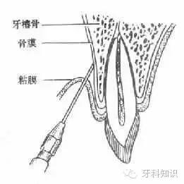 口腔拔牙图片,口腔拔牙麻醉多久消退