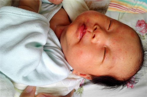 治疗痱子是最好的方法,大人治疗痱子最快速有效的方法