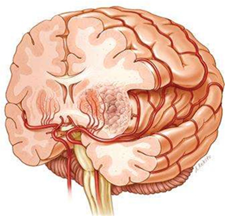 脑胶质瘤手术后复发了还能活多久,脑胶质瘤复发必须手术吗