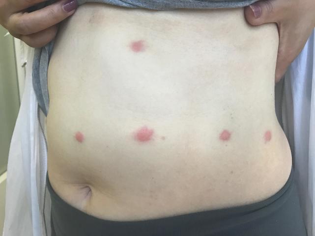 被蚊子或者跳蚤咬了起包超级痒,被蚊子吸了血后会有什么状况