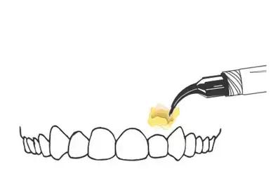 口腔麻醉方法,睡眠麻醉口腔