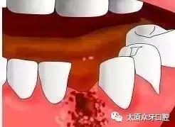 拔牙后出现干槽症有什么症状,拔牙后如何预防干槽症