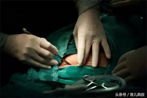 剖腹产一周后伤口崩了,剖腹产后伤口总是反复崩裂