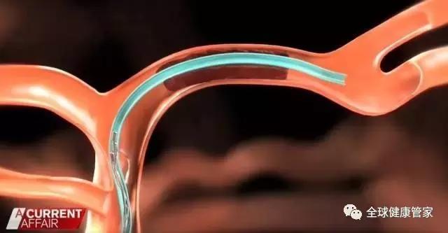 澳洲治疗中风可怕副作用,澳洲十大黑科技药