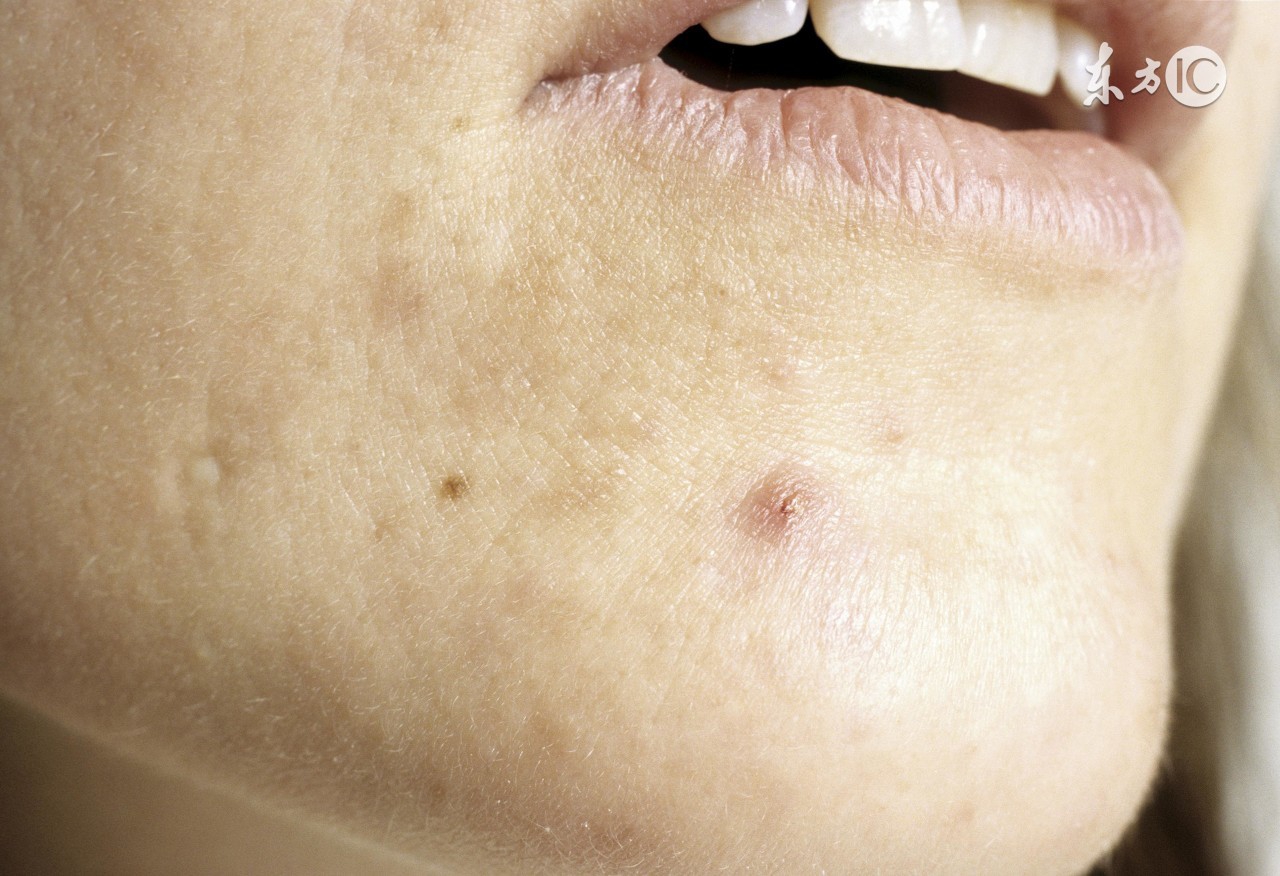 闭口粉刺最有效快速的方法,闭口粉刺最快最有效的办法