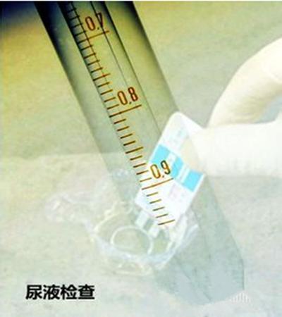 怀孕尿检什么指标,尿检指标科学解读