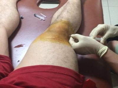 膝盖半月板损伤的锻炼方法,治疗膝盖半月板损伤的方子