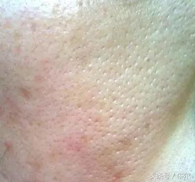 成年了还长痘咋治,50岁的女人脸上还长痘是什么原因