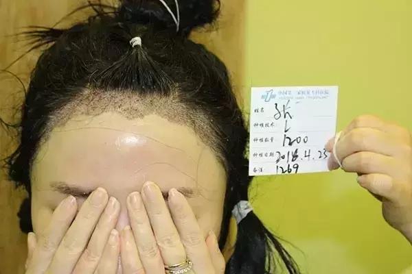 做了发际线还会长吗,做了发际线头型是不是比较好看