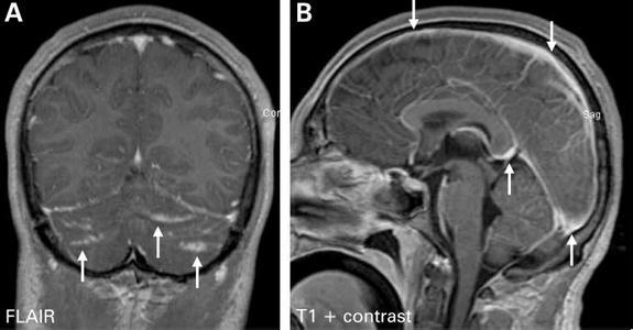 解剖鸽子后重病住院，52天医疗费高达十万元，新型隐球菌脑膜炎究竟是什么？附治疗建议