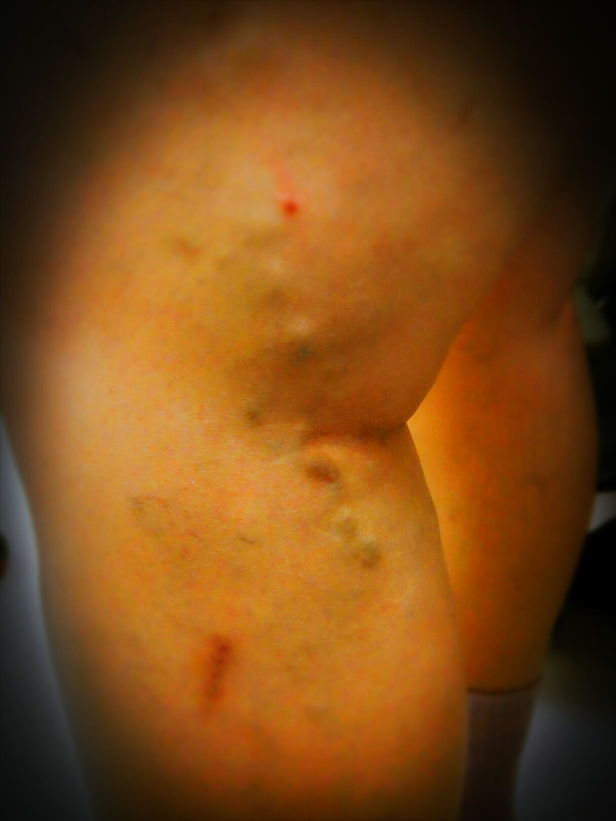 下肢静脉曲张手术后为什么会复发,下肢静脉曲张手术后复发后严重吗