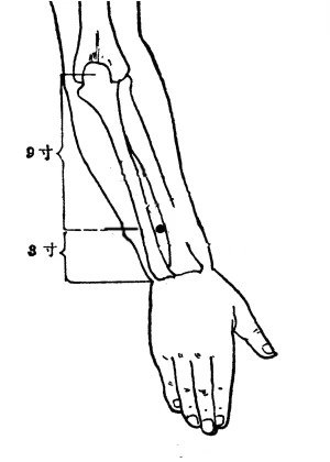 中医治疗疼痛的针灸方法,针灸治疗各种疼痛的穴位