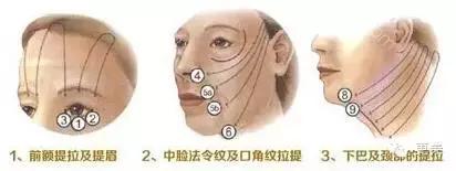 埋线美容线和不吸收线有什么区别,医院埋线和美容院埋线有什么差别