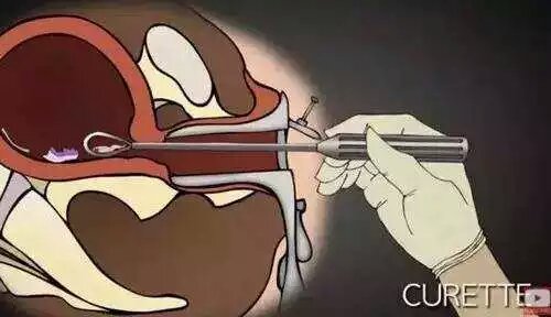 男的会接受女朋友打胎吗,你会建议你的女朋友打胎吗