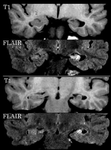 癫痫治疗最新医学动态,中医癫痫讲解视频
