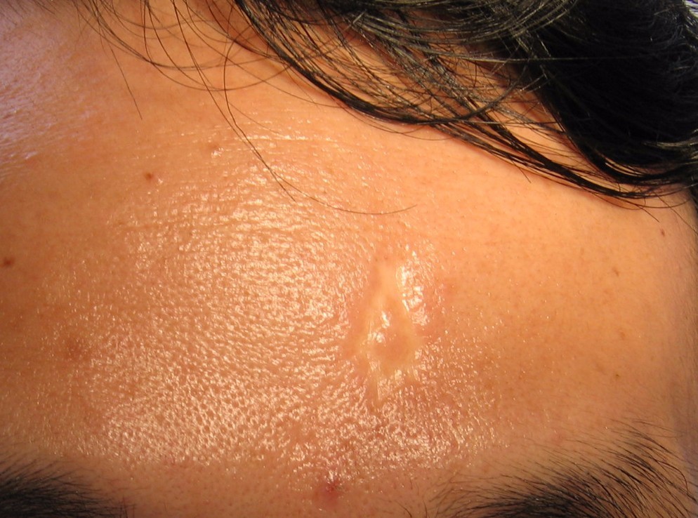 10年的手术疤痕,十年的手术疤痕