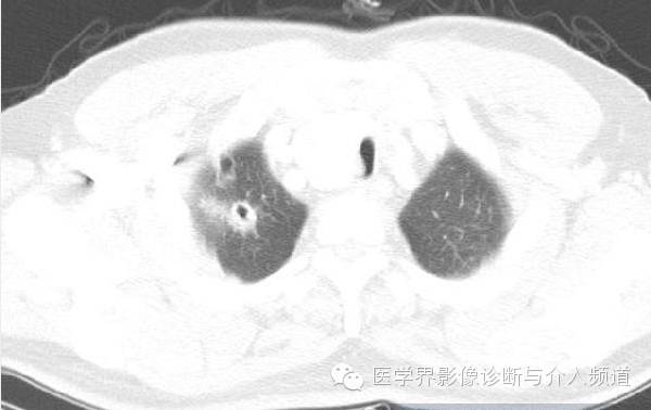 咳嗽排除了肺部的问题,咳嗽为什么比不咳好