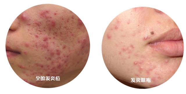 十年战痘血泪史详解,战痘知识分享