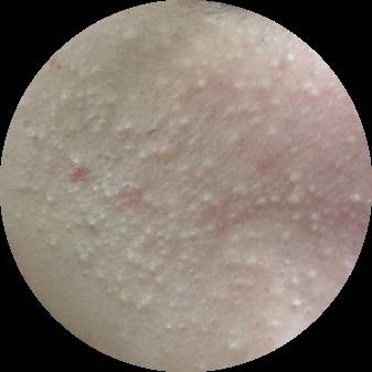 十年战痘血泪史详解,战痘知识分享