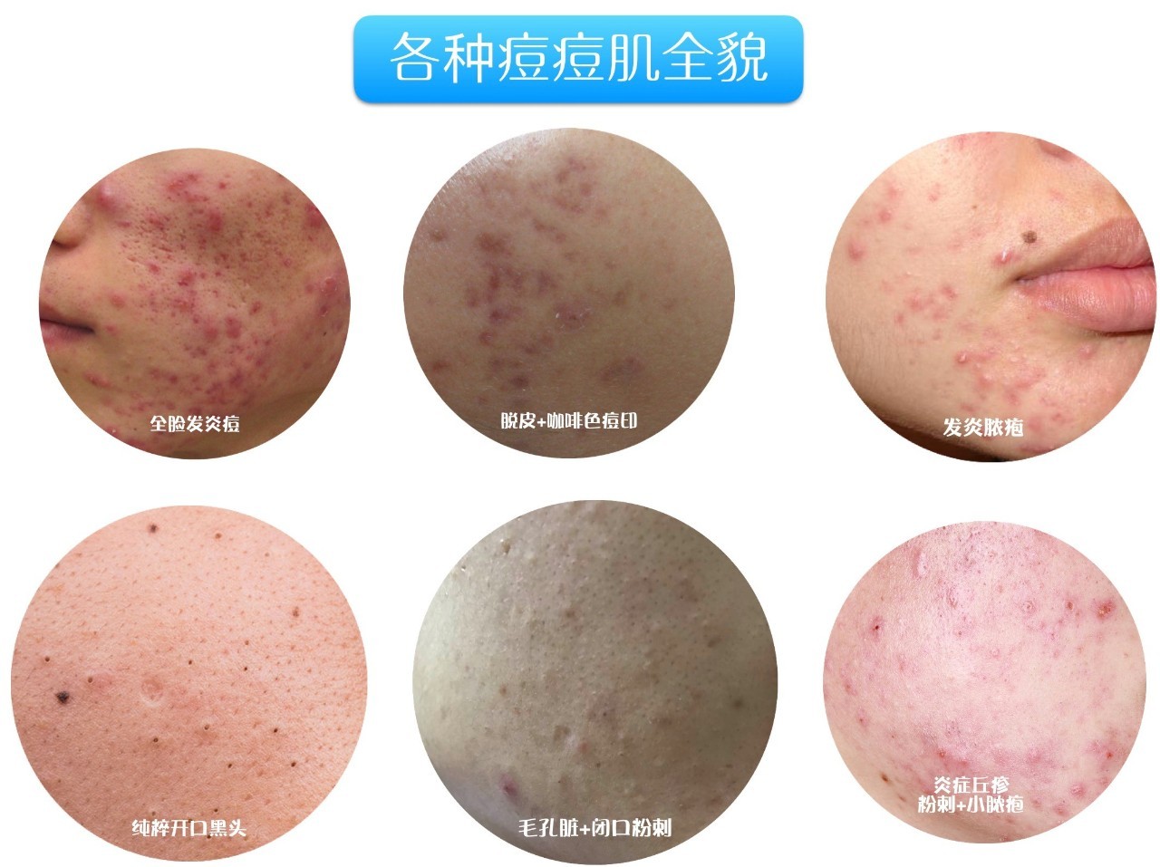 战痘｜史上最全”战痘“解答50+合集！