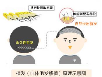 严重脱发秃顶发际线后移如何改善,长期熬夜导致发际线后移秃顶脱发