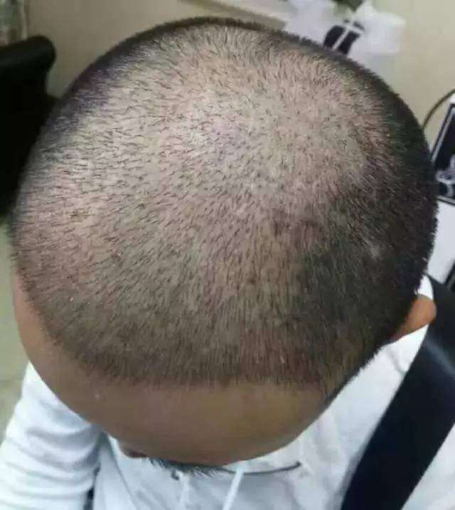 严重脱发秃顶发际线后移如何改善,长期熬夜导致发际线后移秃顶脱发