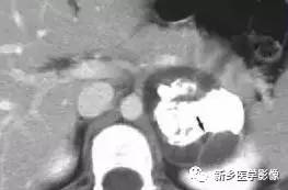 18种疾病包括哪些,18种肿瘤有哪些