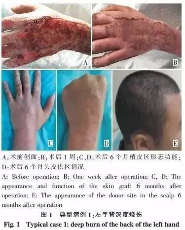 以头皮为供区的大张中厚皮片在创面修复中的应用