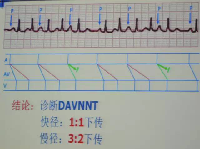 郭继鸿心电图学教程,郭继鸿异常心电图