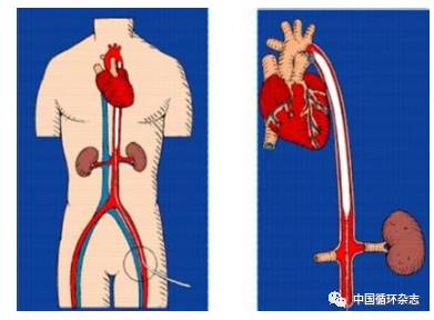 「CHC2017」搭桥术后IABP护理专家共识发布