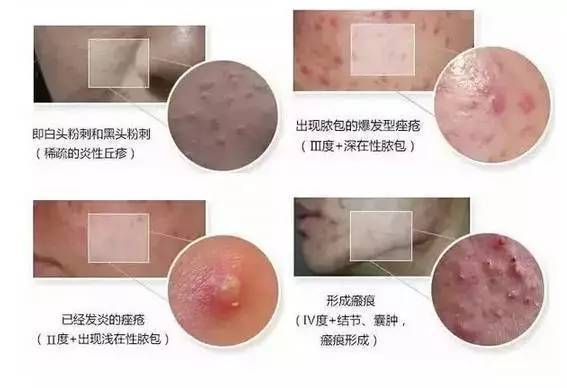 祛痘小窍门掌握了就不会有烦恼,最全祛痘攻略快速祛痘不留痕