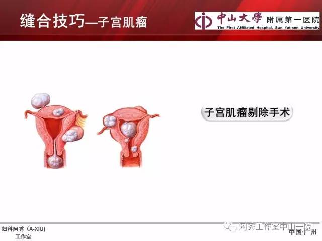 妇科腹腔镜下常用缝合技巧